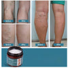 Image of Varicose Vein Relief Cream - Soothing Formula for Varicose and Spider Veins on Legs