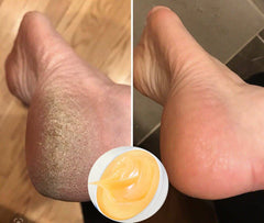 Urea Cream 40% Cracked Skin Repair, Best Lotion for Callus Feet, Hydrating Cream