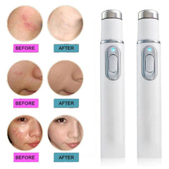 Blue Light Therapy Laser Pen for Wrinkle and Acne Treatment with Soft Scar Removal