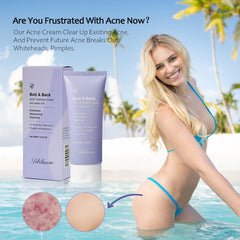 Comprehensive Acne Treatment for Back, Buttocks, and Body